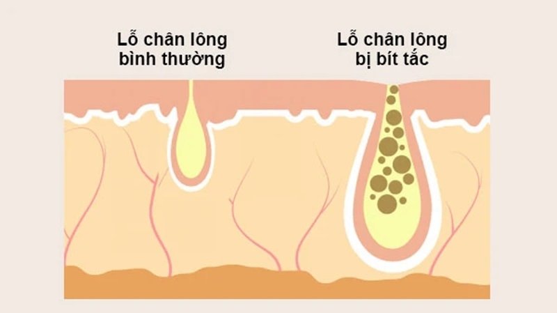 nguyen nhan gay bit tac lo chan long