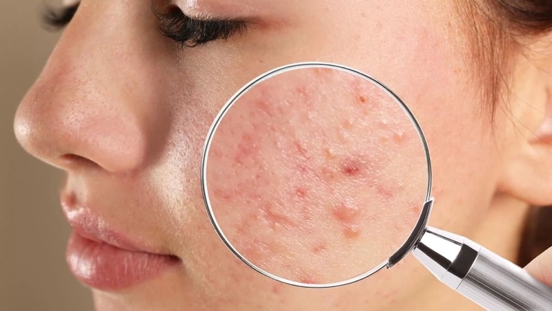 Da dầu mụn có nên tẩy tế bào chết thường xuyên không da dau mun co nen tay te bao chet thuong xuyen khong