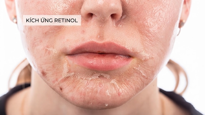 Dung retinoid bi kich ung phai lam sao