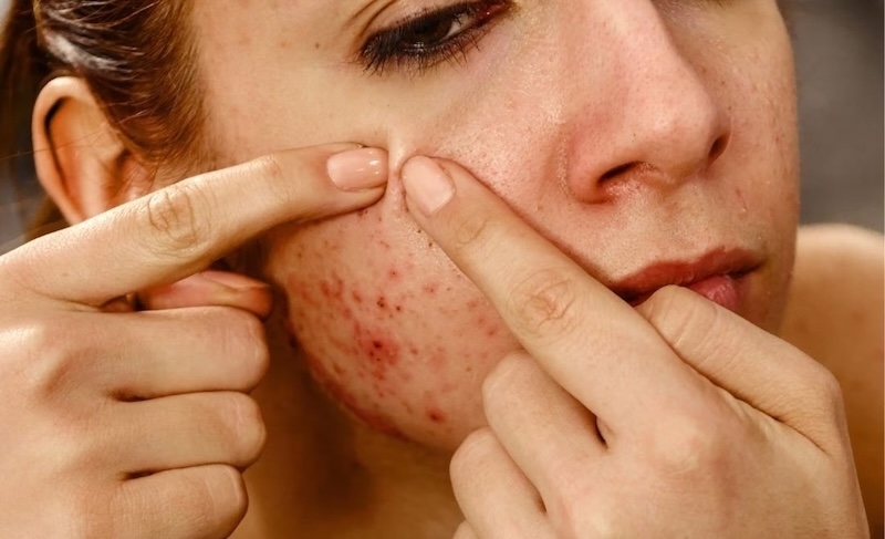 Những sai lầm khi chăm sóc da mụn nhung sai lam khi cham soc da mun