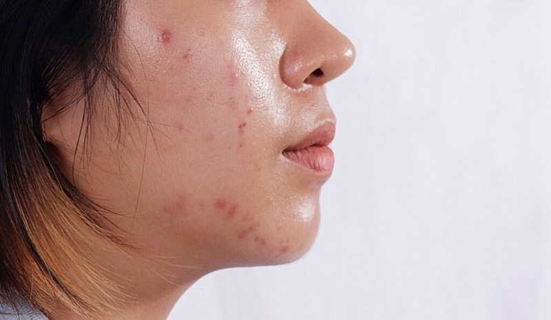 nguyen nhan khien mun tai phat lien tuc