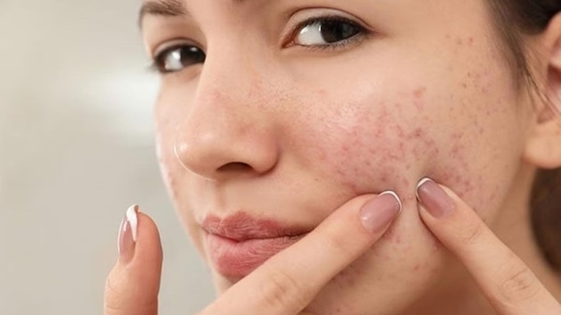 Nguyên nhân khiến mụn tái phát liên tục nguyen nhan khien mun tai phat lien tuc
