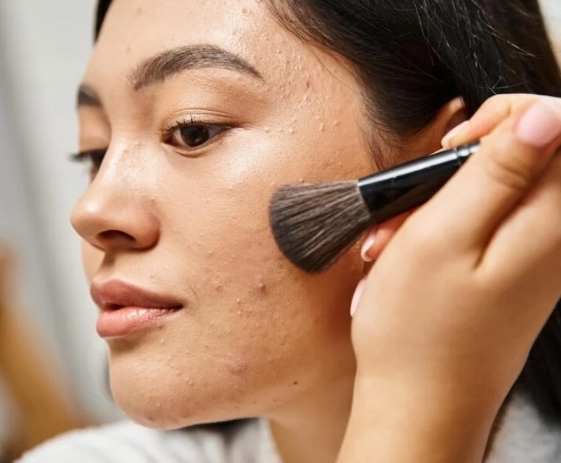 Nguyên nhân khiến mụn tái phát liên tục nguyen nhan khien mun tai phat lien tuc