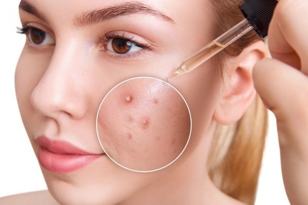 Da dầu mụn nên dùng Niacinamide nồng độ bao nhiêu da dau mun nen dung niacinamide nong do bao nhieu