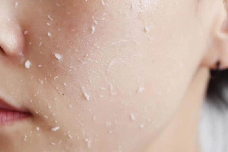 Da dầu mụn có nên tẩy tế bào chết thường xuyên không da dau mun co nen tay te bao chet thuong xuyen khong