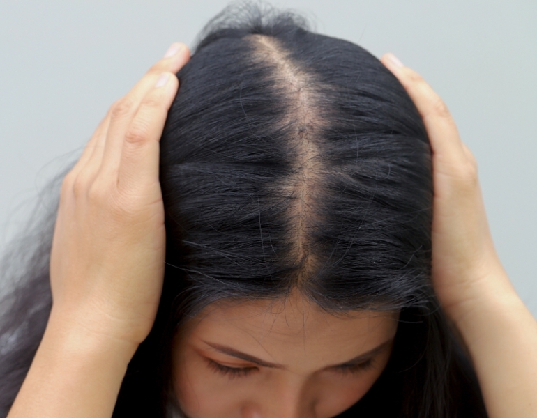 T&igrave;nh trạng rụng t&oacute;c ở nữ giới