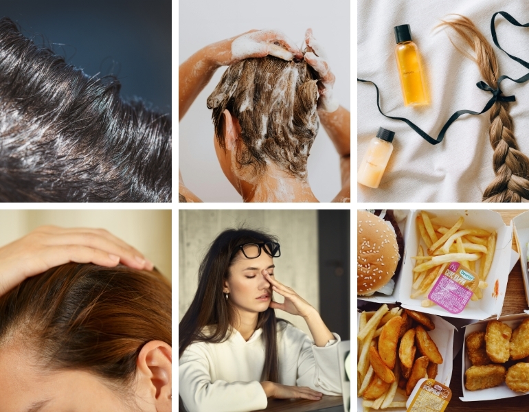 Nguy&ecirc;n nh&acirc;n khiến da đầu dầu v&agrave; t&oacute;c nhanh bết