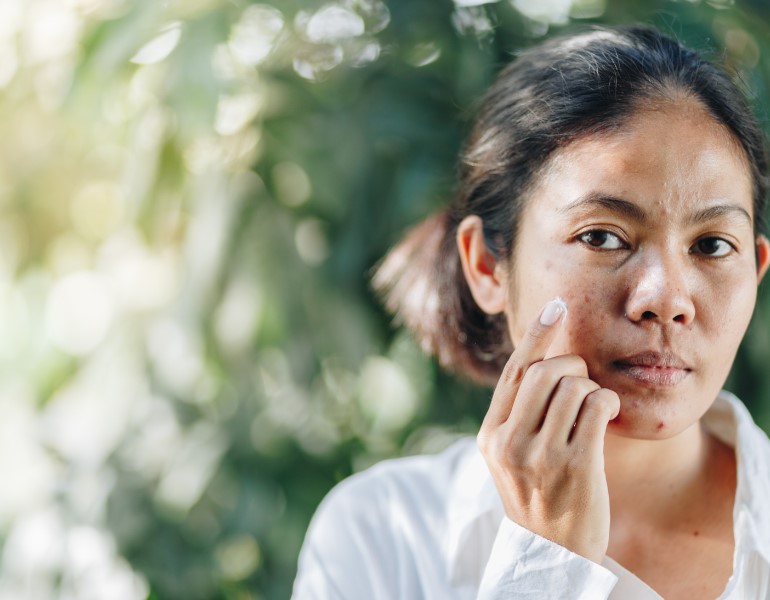 Công dụng của chiết xuất rau má trong việc làm mờ vết thâm nám trên da mặt