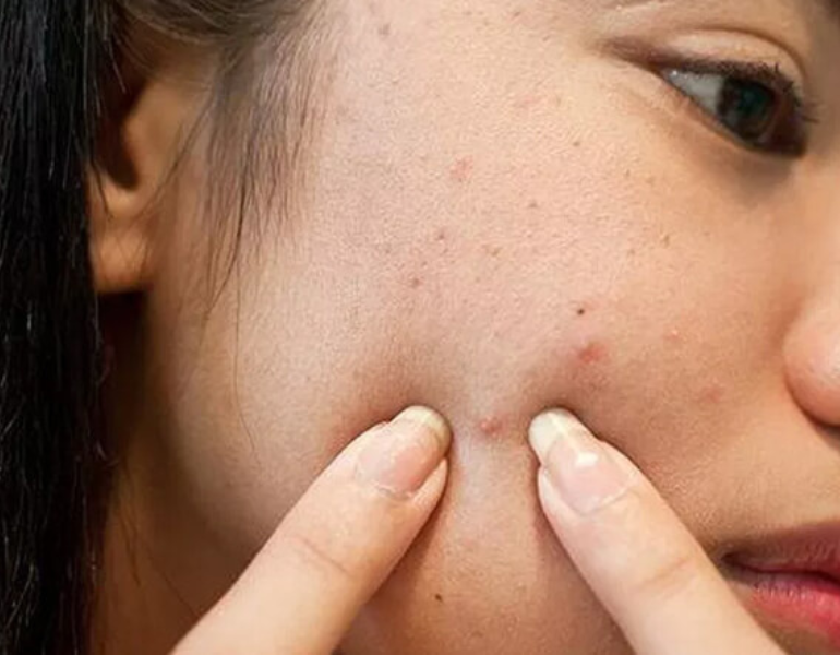 Hạn chế chạm tay lên da mặt giúp giảm thiểu nguy cơ tiếp xúc vi khuẩn từ tay