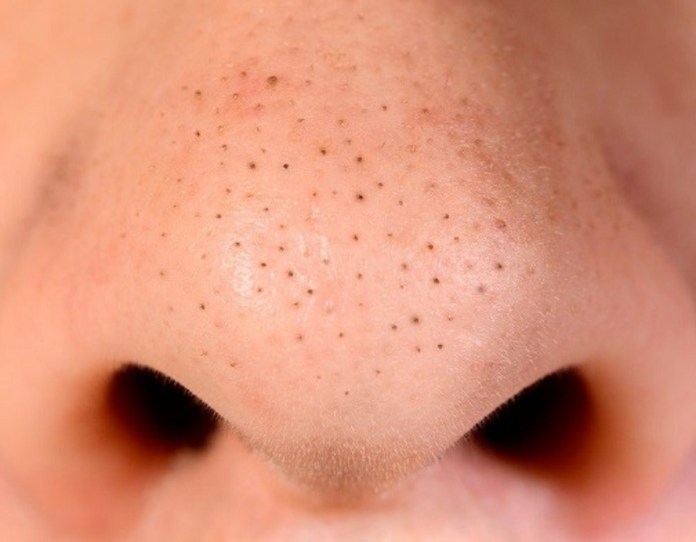 Mụn đầu đen là một trong các loại mụn thường gặp trên da mặt