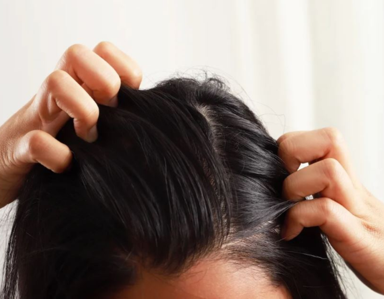 Da đầu đổ nhiều dầu có thể là do bạn gội đầu không sạch