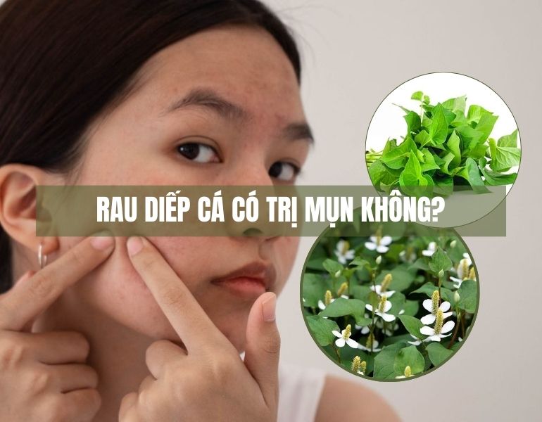 Rau diếp cá có trị mụn không?